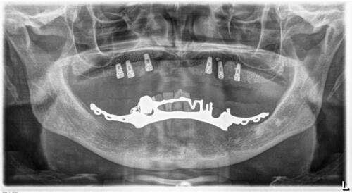 1-conical-grade-sg-implant-vittorio-danniballe-(17)