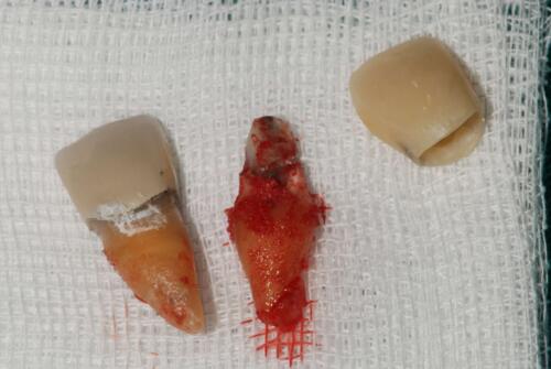 3-conical-grade-sg-implant-vittorio-danniballe (11)