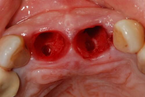 3-conical-grade-sg-implant-vittorio-danniballe (13)