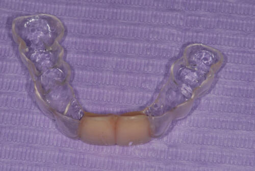 3-conical-grade-sg-implant-vittorio-danniballe (17)