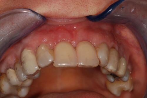 3-conical-grade-sg-implant-vittorio-danniballe (19)