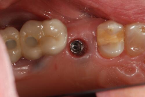 4-conical-grade-sg-implant-vittorio-danniballe (11)