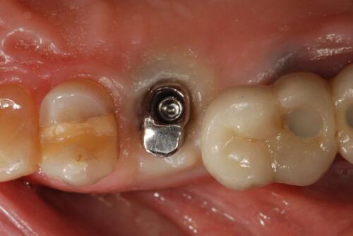 4-conical-grade-sg-implant-vittorio-danniballe (2)