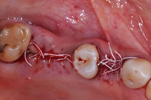 5-conical-grade-sg-implant-vittorio-danniballe (5)