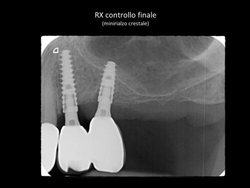 Messina-M. Conical-Grade-Diapositiva5