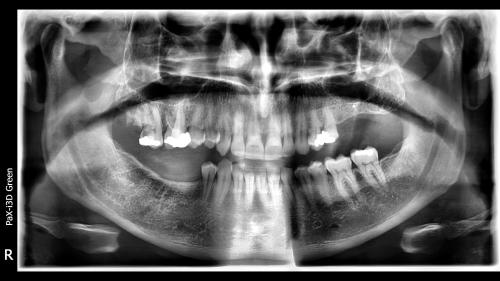 dott-arturo-marrone-conical-grade-2-sg-implant-pescara (1)