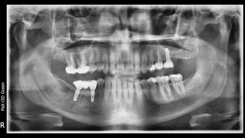 dott-arturo-marrone-conical-grade-2-sg-implant-pescara (7)