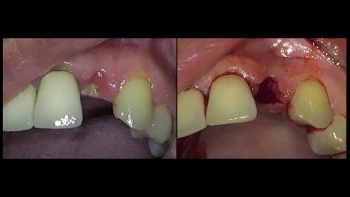 dott-arturo-marrone-conical-grade-3-sg-implant-pescara (2)