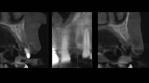 dott-arturo-marrone-conical-grade-3-sg-implant-pescara (5)