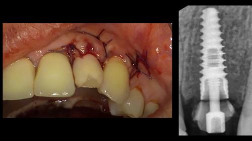 dott-arturo-marrone-conical-grade-3-sg-implant-pescara (7)