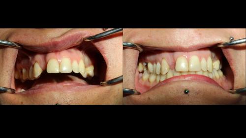 dott-arturo-marrone-conical-grade-4-sg-implant-pescara (1)