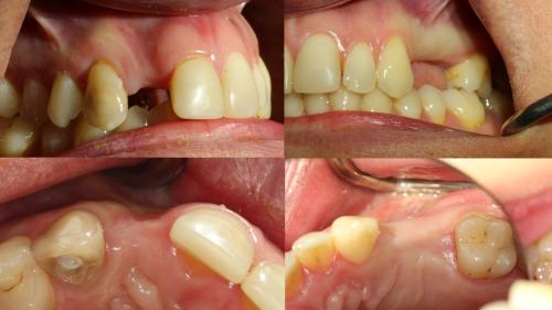 dott-arturo-marrone-conical-grade-4-sg-implant-pescara (2)