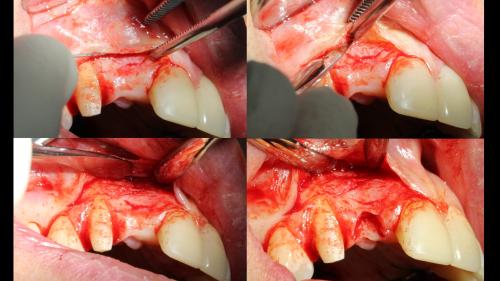 dott-arturo-marrone-conical-grade-4-sg-implant-pescara (3)