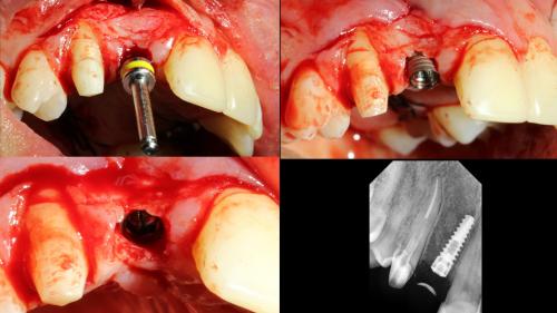 dott-arturo-marrone-conical-grade-4-sg-implant-pescara (4)