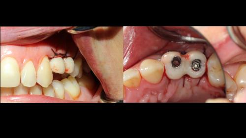 dott-arturo-marrone-conical-grade-4-sg-implant-pescara (7)