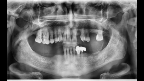 dott-arturo-marrone-conical-grade-sg-implant-pescara (1)