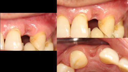 dott-arturo-marrone-conical-grade-sg-implant-pescara (2)