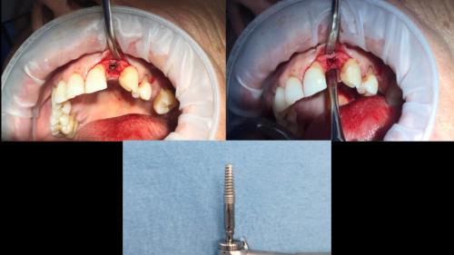 dott-arturo-marrone-conical-grade-sg-implant-pescara (3)