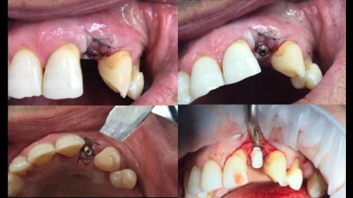 dott-arturo-marrone-conical-grade-sg-implant-pescara (4)