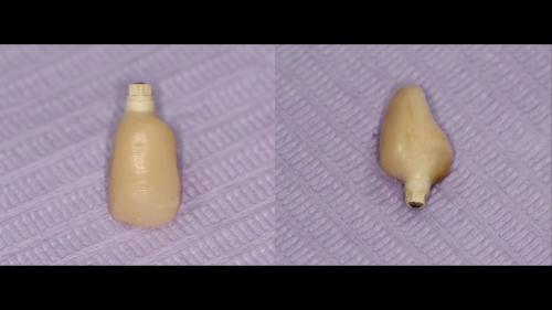 dott-arturo-marrone-conical-grade-sg-implant-pescara (6)