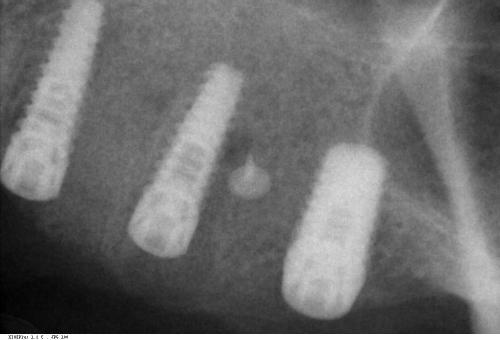 dott.-domenico-di-croce-sg-implant-vittorio-danniballe (14)