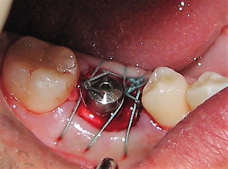 post-estrattivo-conical-grade-sg-implant-vittorio-danniballe (9)